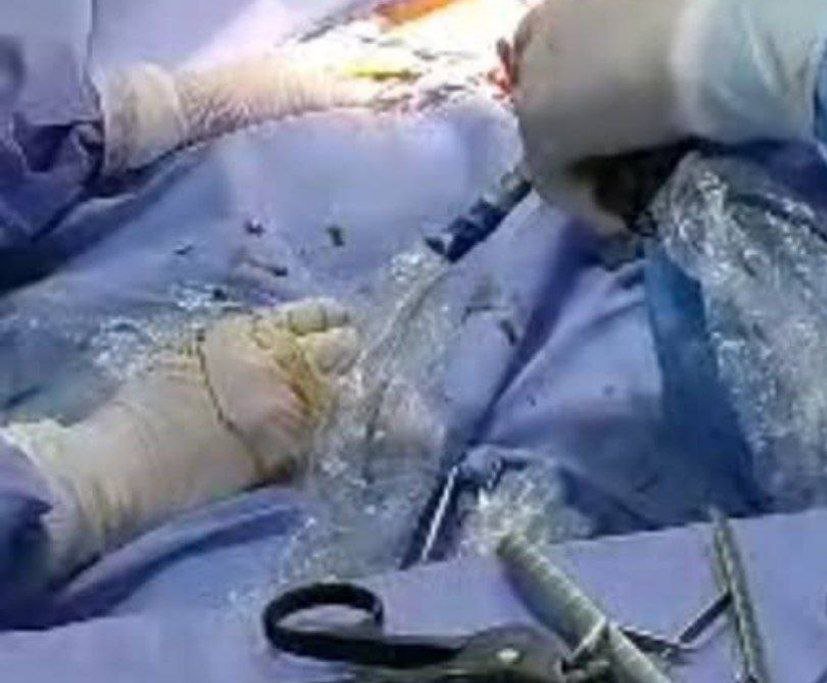 جراحی نوین رباط صلیبی زانو برای نخستین&zwnj;بار در شفاخانه حوزوی هرات انجام شد